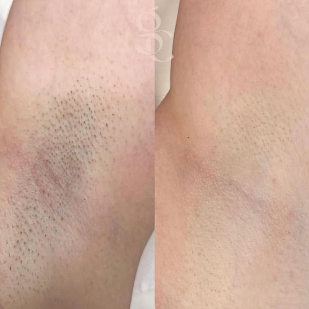 Laser Hair Removal Before and After 2