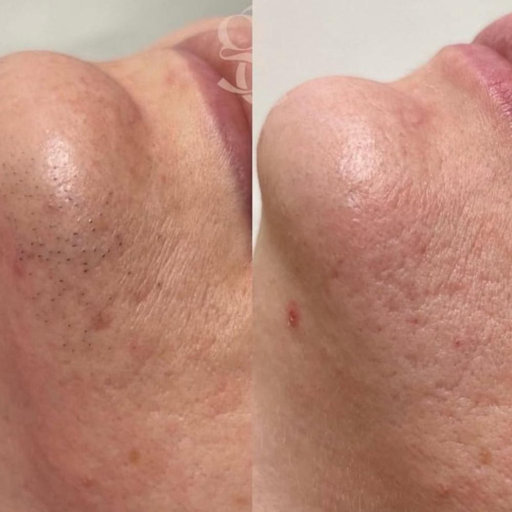 Laser Hair Removal Before and After 3
