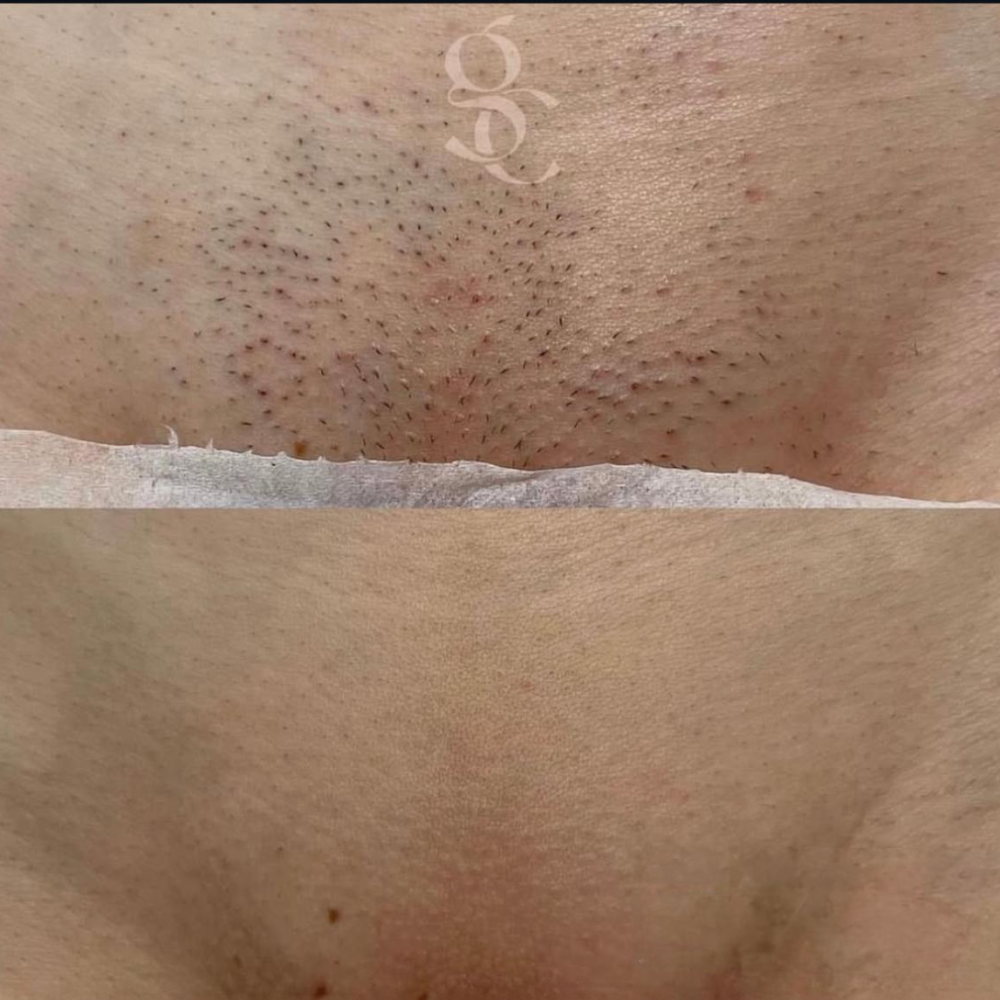 Laser-Hair-Removal-Before-and-After-4